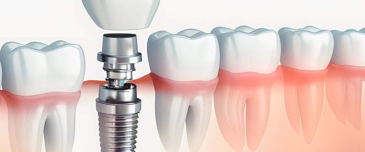 Dental Implants