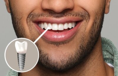 Dental implant result