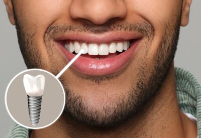 Dental implant result