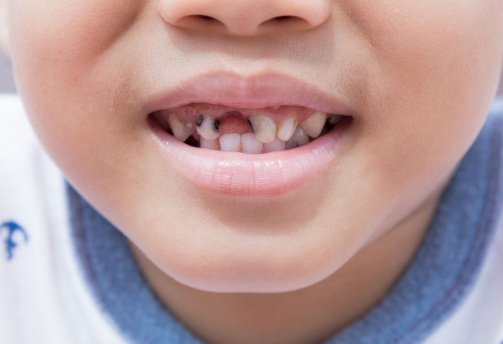 tooth decay in kids