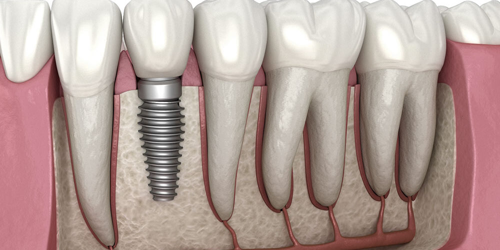 Dental Implants