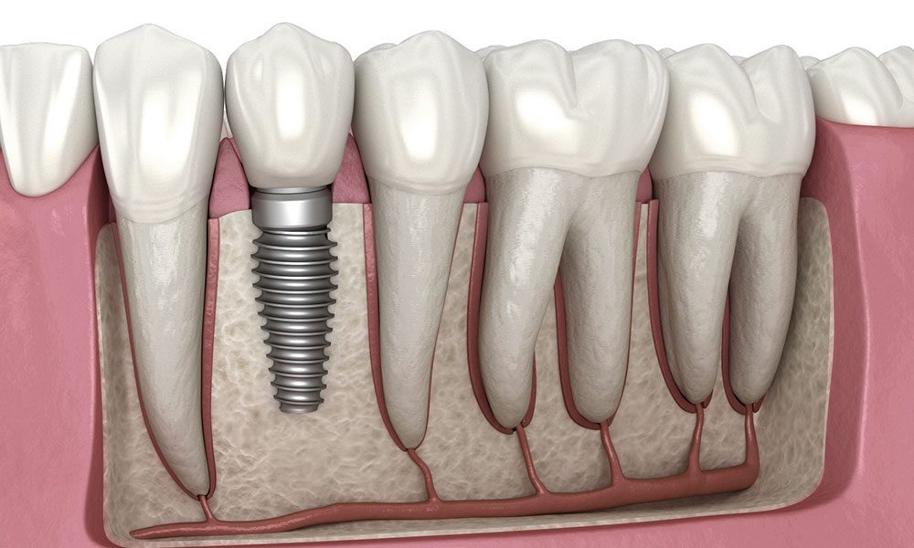 Dental Implants