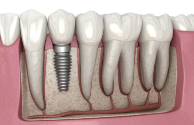 Dental Implants