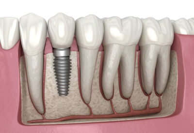 Dental Implants