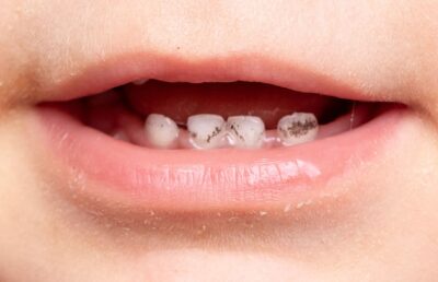 Tooth Decay in kids