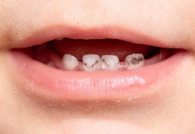 Tooth Decay in kids