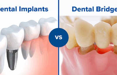 Dental Implants vs Bridges