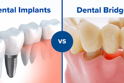 Dental Implants vs Bridges