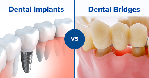 Dental Implants vs Bridges