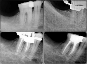 root canal treatment