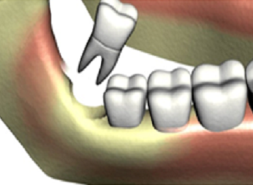 Dental Extraction